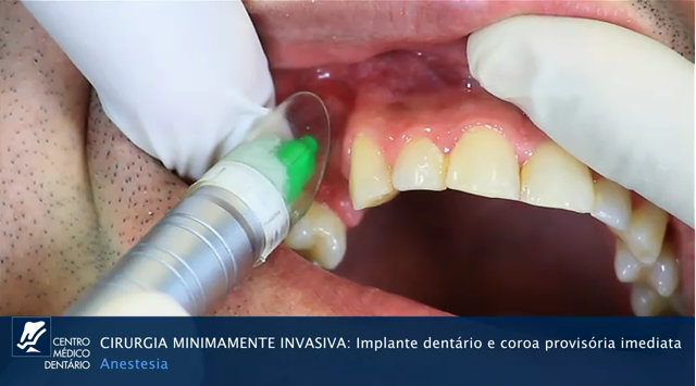 Esterilização Esterilização